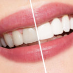 Teeth whitening in Mount Waverley