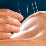 Acupuncture Clinic Pickering