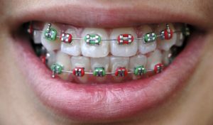 affordable braces