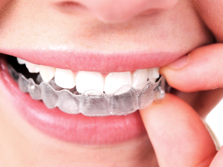 affordable invisible braces