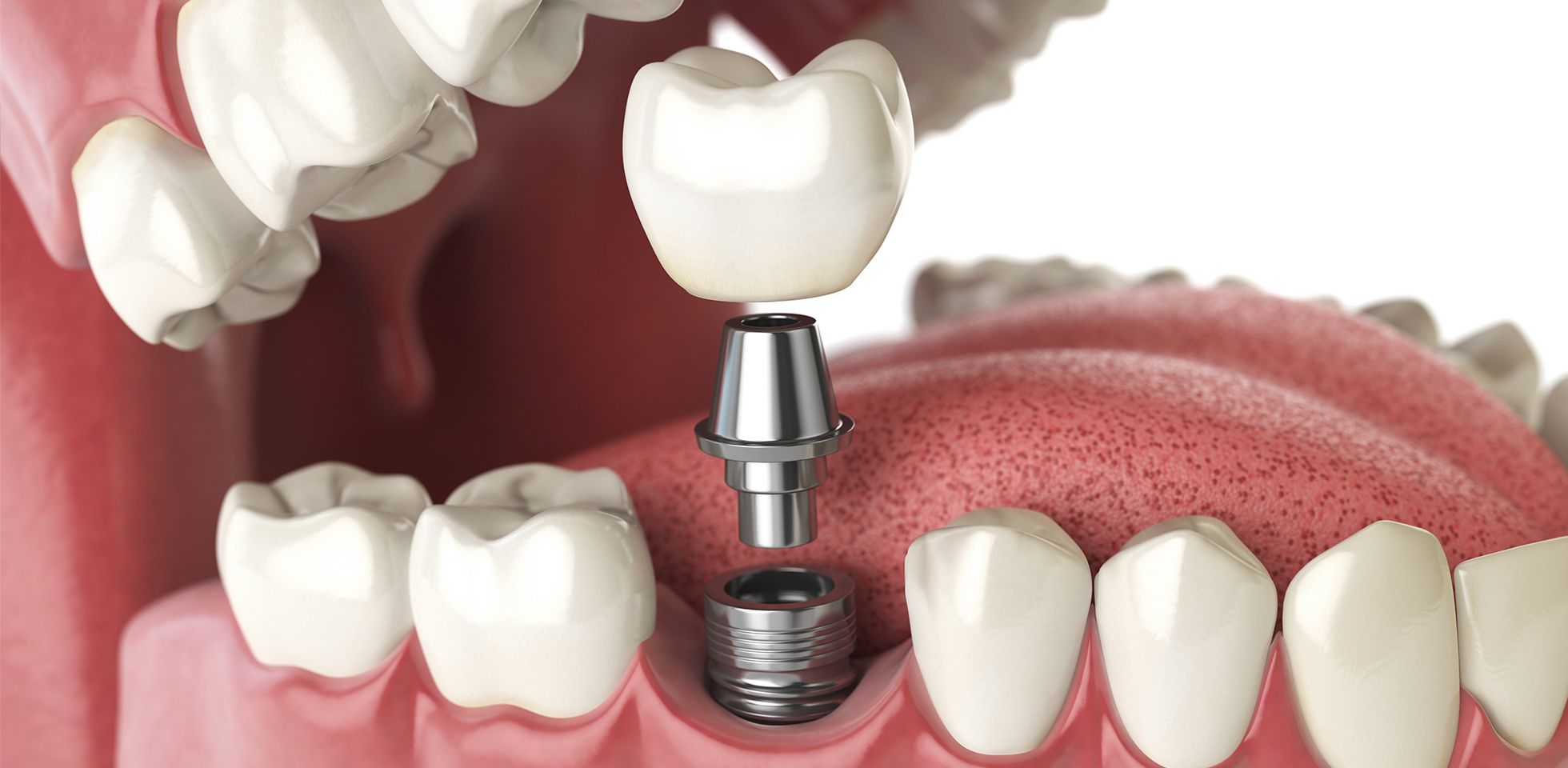 Liverpool implant dentist