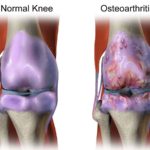 osteoarthritis treatment Brisbane
