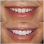 natural looking veneers