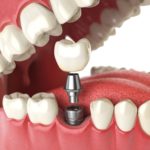 Dental implants Greensboro NC