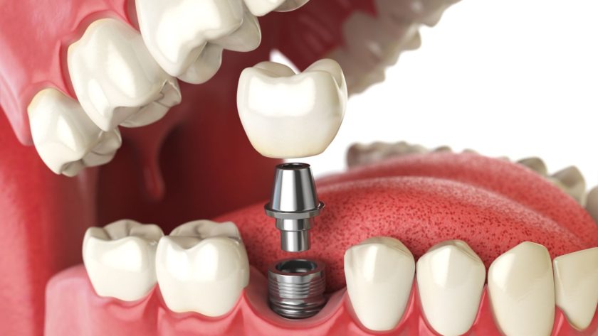 Dental implants Greensboro NC