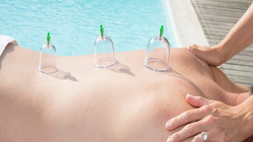 cupping treatment