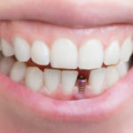 dental implants Maroochydore