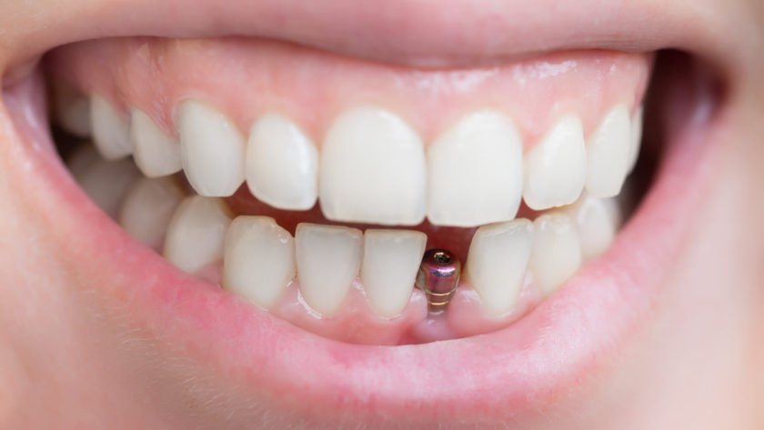 dental implants Maroochydore