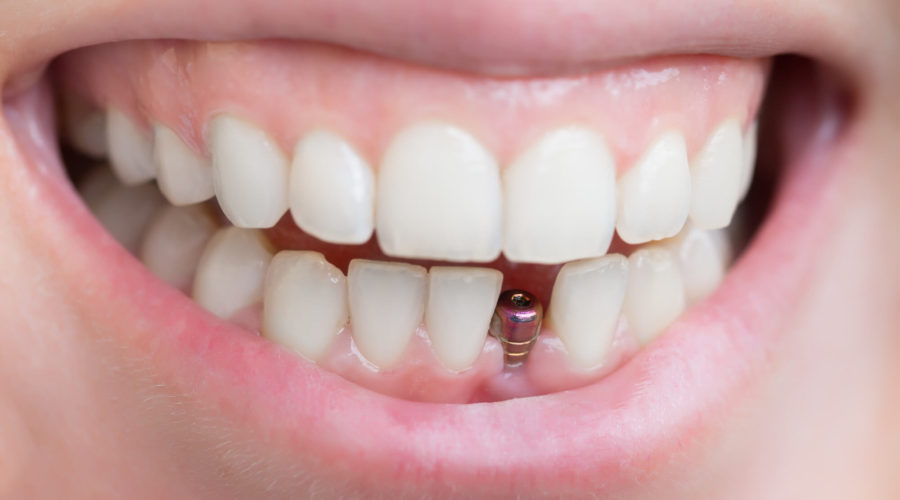 dental implants Maroochydore