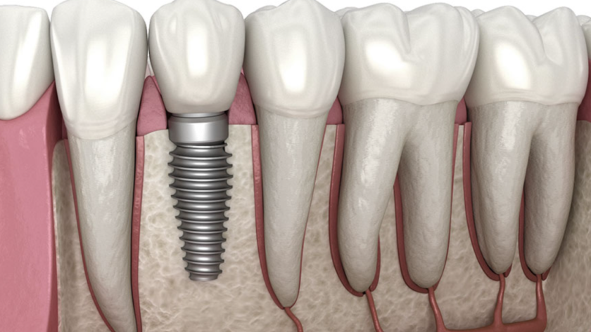 Dental implants in Ottawa