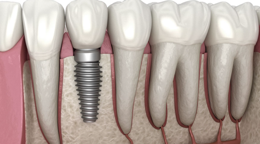 Dental implants in Ottawa