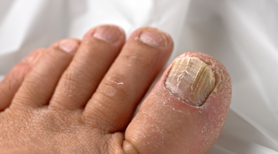 anti fungal nail treatment