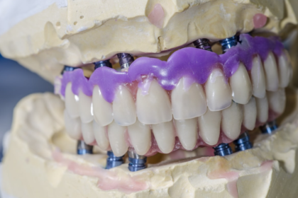 Ottawa dental implants