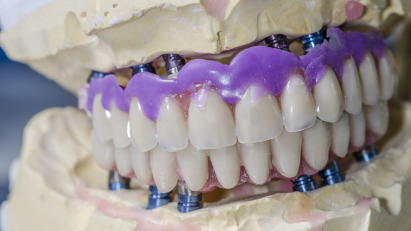 Ottawa dental implants