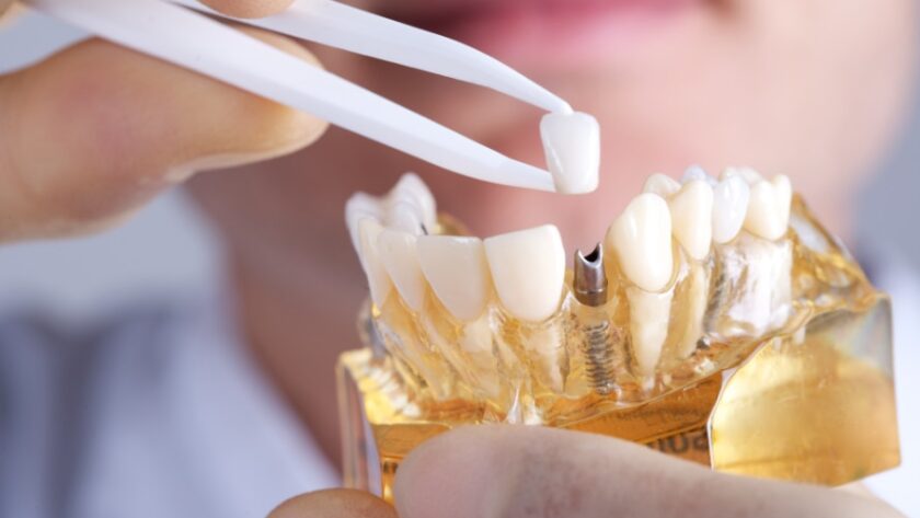 dental implants in Campsie