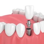 dental implants in Northern Rivers.