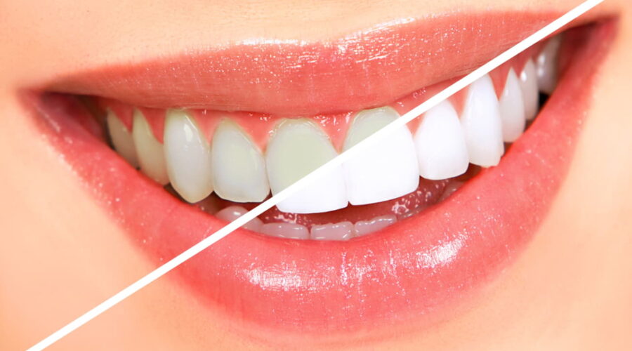 Tooth whitening