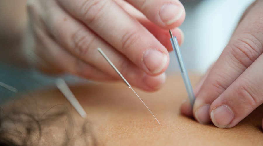 Acupuncture in Epsom