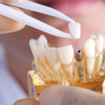 Dental implants in Northern Rivers