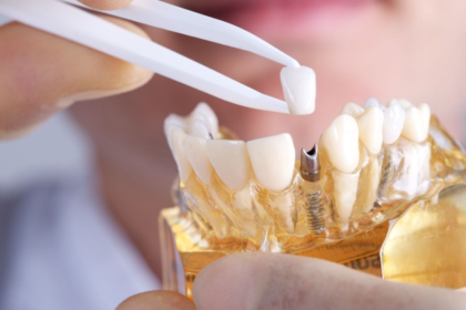 Dental implants in Northern Rivers