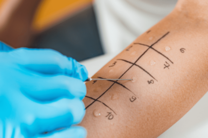 where to get a penicillin allergy test