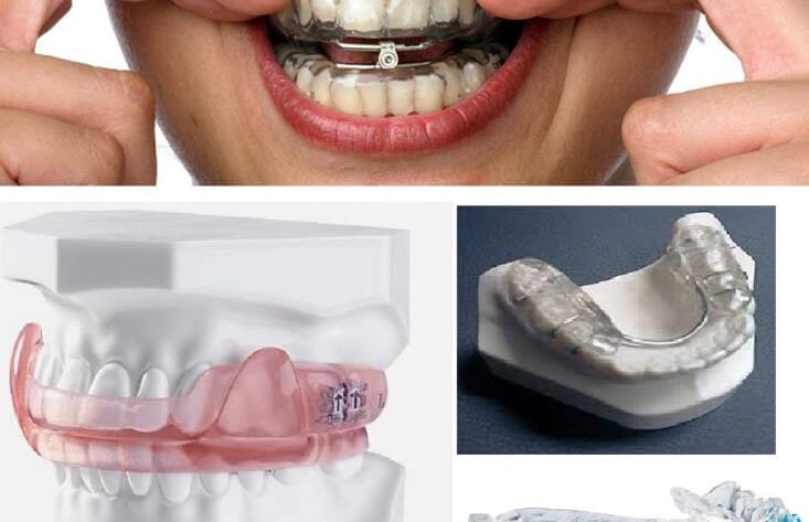 dental appliances for sleep apnea