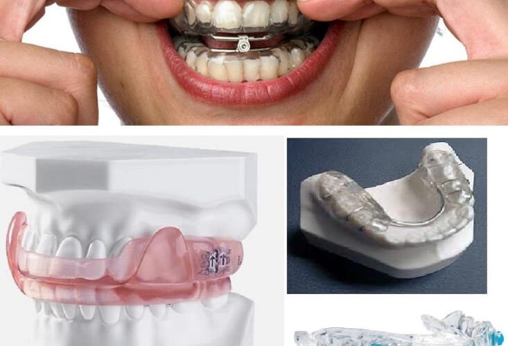 dental appliances for sleep apnea