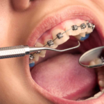 orthodontic treatment