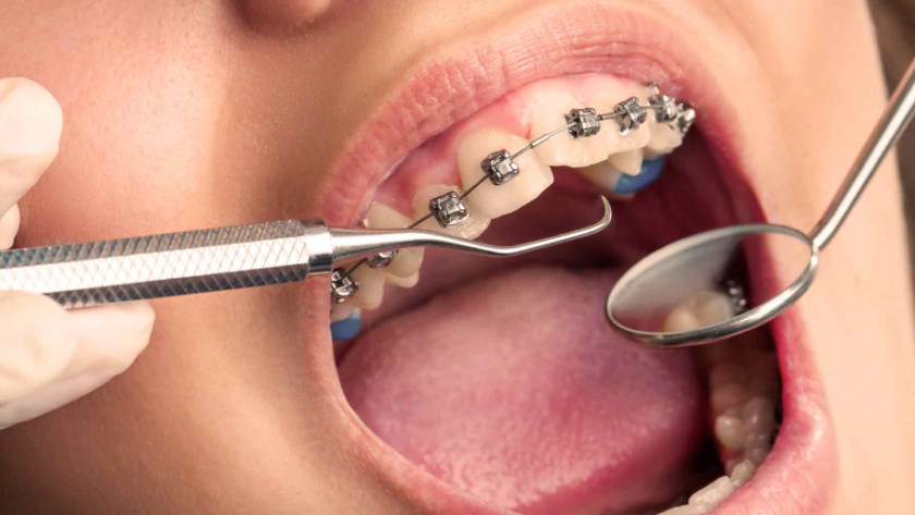 orthodontic treatment