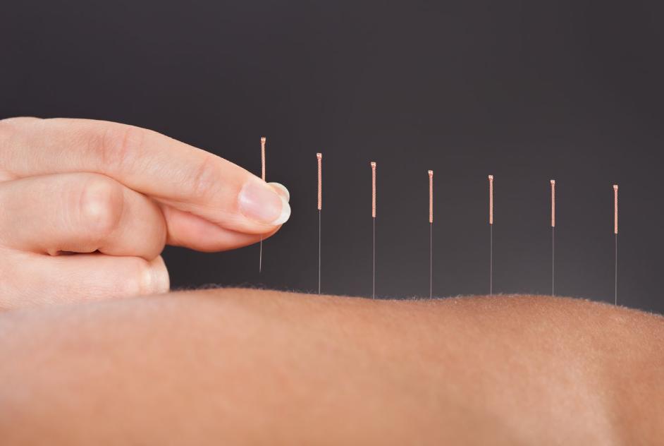 Chinese medicine and acupuncture